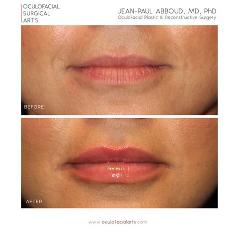 Lip Augmentation And Enhancement Anatomy Of A Perfect Pout