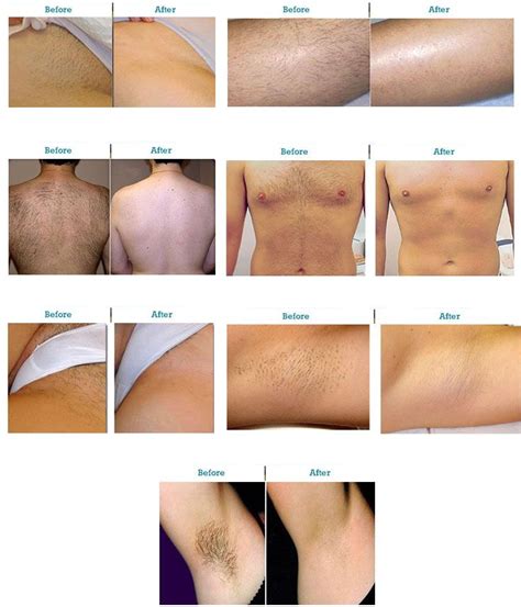 Before And After Results Of Laser Hair Removal Using The Gold Standard