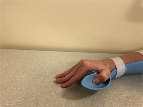 Hand Therapy Exercises Following Extensor Pollicis Longus Epl