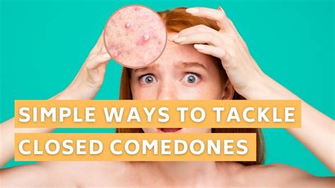 How To Treat Closed Comedones With Simple Routines 9 Tips You Must