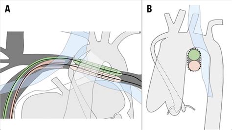 Oval Stenting In Left Pulmonary Artery Stenosis A Novel Double Balloon