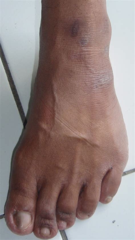 Seseorang juga akan kehilangan kepercayaan diri hanya karena tonjolan dari bekas luka hitam jeruk nipis : Cara Menghilangkan Bekas Luka ~ Artikel Kesehatan