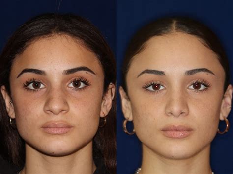 Ethnic Nose Job Before And After Maryland Somers