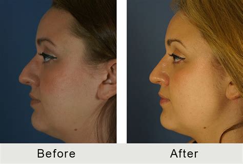 Post Rhinoplasty Before And After Carolina Facial Plastics