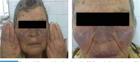 Amiodarone Induced Skin Pigmentation Two Clinical Cases Semantic