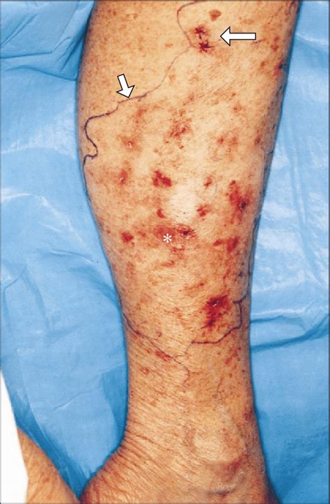 Patient 1 Large Amelanotic Melanoma Of The Leg The Perimeter Of The