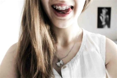 Braces Braces Handsome Body People Mouth Beautiful Girls Metal