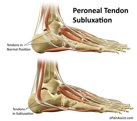 Peroneal Tendon Subluxation Treatment Recovery Exercises Symptoms