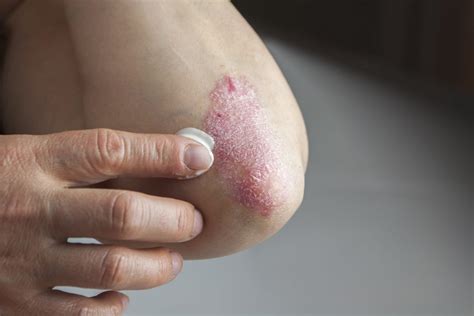 Treatment Of Atopic Dermatitis With Tapinarof Cream Eczema Awareness