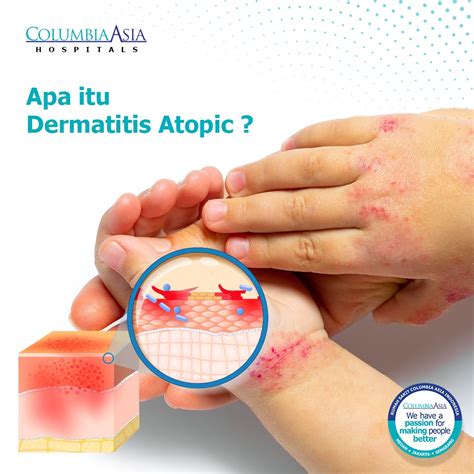 Apa Itu Dermatitis Atopik Columbia Asia Hospital Indonesia