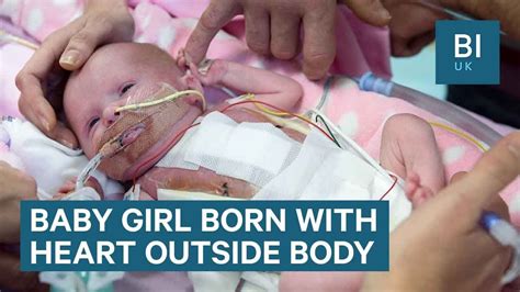 Baby Born With Heart Outside Her Body Becomes First Uk Child To Survive