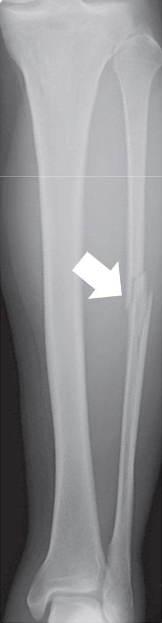 Maisonneuve Fracture A Type Of Ankle Fracture Bmj Case Reports