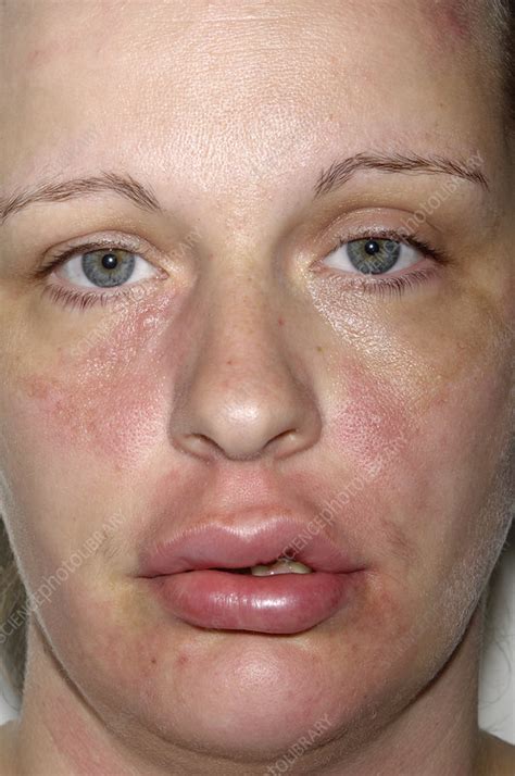 How To Treat Swollen Lips From Allergies