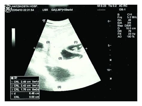 Ultrasound Examination Shows An Intrauterine Twin Pregnancy 1 2 With