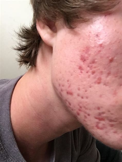 How Severe Is My Acne And What Can Be Done To Help It General Acne