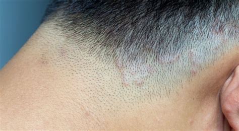 Patterned Hair Loss Treatments Melbourne Sinclair Dermatology
