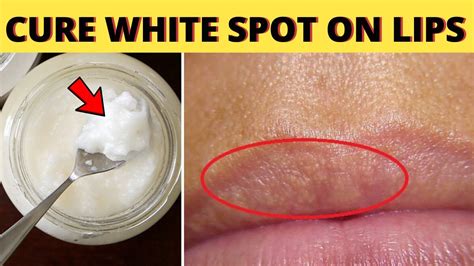 This Remedy Will Naturally Cure White Spots On Lips Fast And