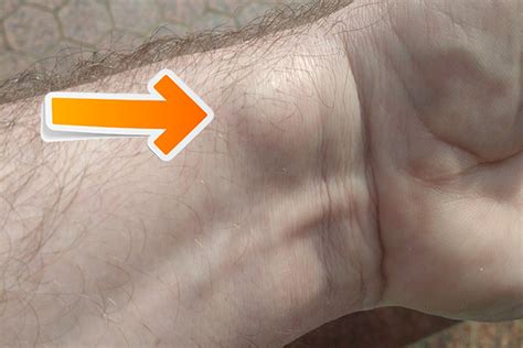 Where Do Ganglion Cysts Appear Ganglion Cysts Information