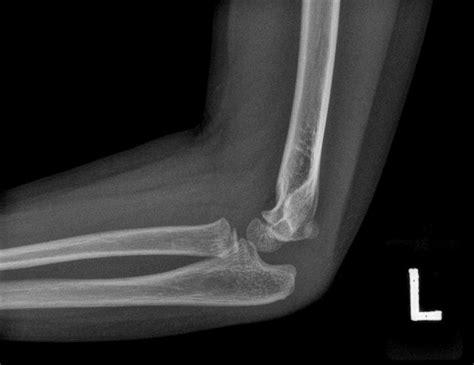 Elbow Joint Effusion Buyxraysonline
