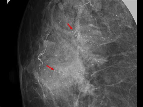 Atlas Of Breast Cancer Early Detection