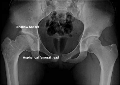Perthes Disease St Louis Mo Open Hip Dislocation Missouri