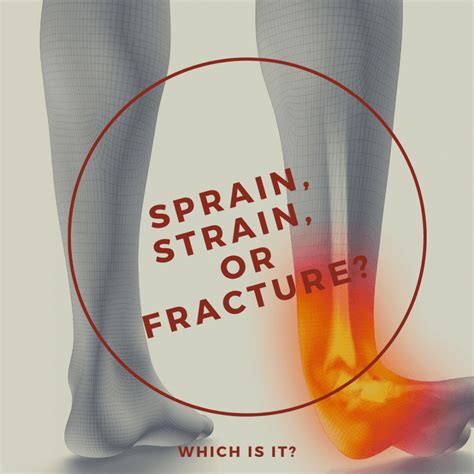 Sprain Strain Or Fracture Which Is It Orthopaedic Institute Of