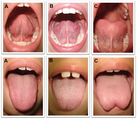 scielo brasil tongue position for lingual frenulum assessment tongue position for lingual