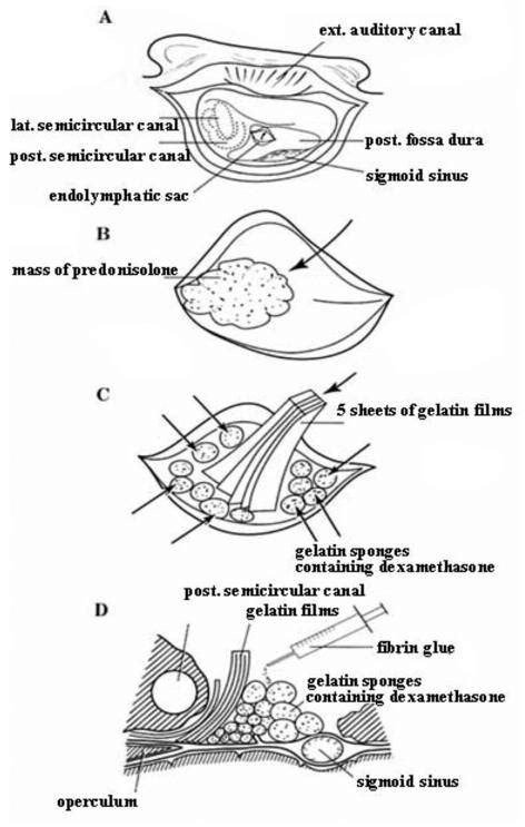 Schematic Representation Of Endolymphatic Sac Drainage And