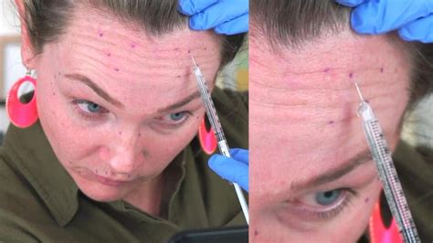People Injecting Fillers Into Their Own Faces Youtube
