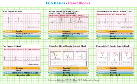 ECG Basics Heart Blocks Diagnosis Cardiology Medbabe GrepMed