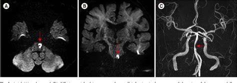 Figure 2 From Ponto Medullary Junction Infarction Presenting As