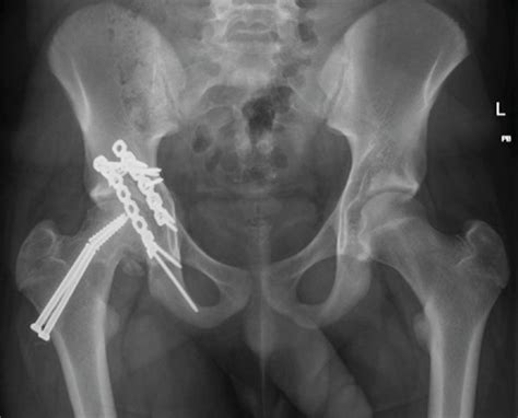 A Ap And B Judet Pelvis Radiographs And C Ap And Lateral Right