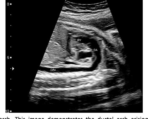 Figure 3 From Fetal Diagnostics And Fetal Intervention Semantic Scholar