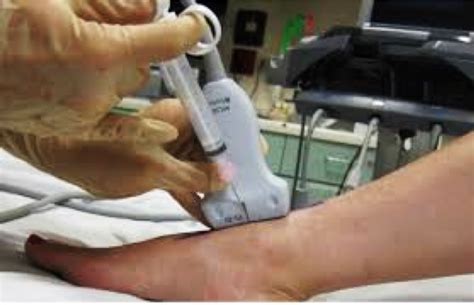 Mastering Minor Care Ankle Arthrocentesis — Taming The Sru