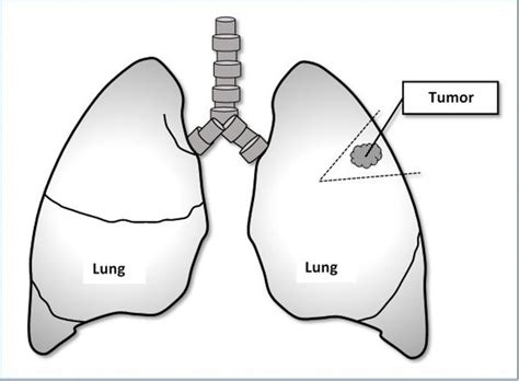 Wedge Resection For Lung Cancer