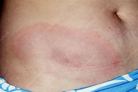 Erythema Migrans Rash In Lyme Disease Stock Image C0213346