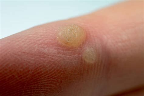 Plantar Wart Stock Photos Pictures And Royalty Free Images Istock