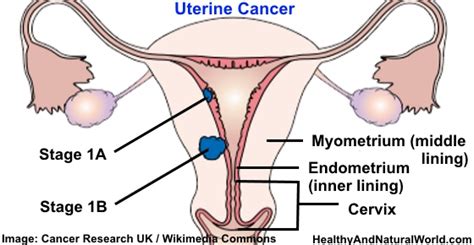 Uterine Endometrial Cancer Symptoms Risk Factors And Prevention