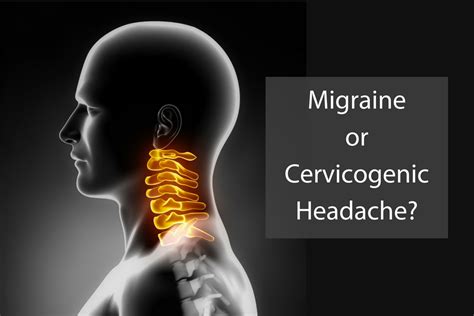 Do You Have A Migraine Or A Cervicogenic Headache Steward