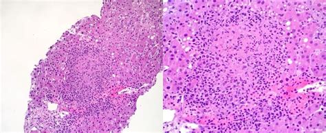 Granulomatous Hepatitis In A Patient With Crohns Disease And