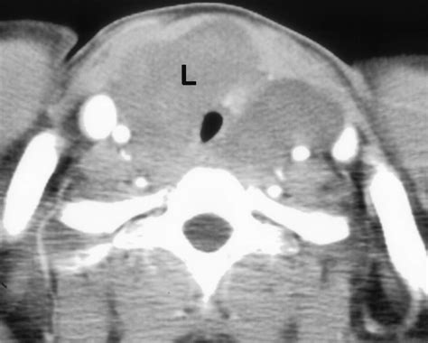 Navigating The Thoracic Inlet Radiographics