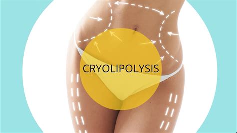 cryolipolysis manchester lipo youtube