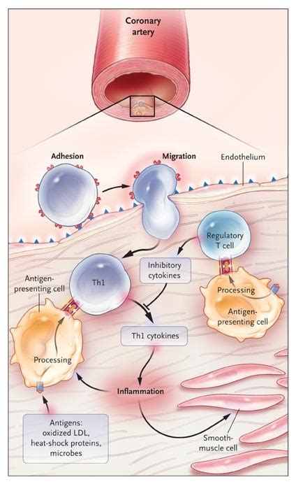 Inflammation Atherosclerosis And Coronary Artery Disease Nejm