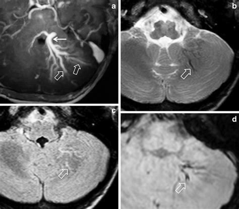 Axial Mr Images Of A Left Cerebellar Developmental Venous Anomaly Dva