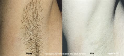 If you must use hair removal cream and can handle the burning sensation, then use the other brand simply because it doesn't leave the stubble which leaves you hair free for much longer! Laser Hair Removal | Bellevue | Seattle | Dermatologist ...
