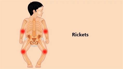 Causes And Symptoms Of Rickets Professional Guide