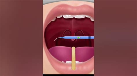 Animated Tonsillitis Operation 1st Video Youtube