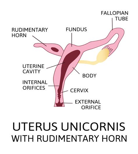 Unicornuate Uterus Treatment Causes Its Type Birla Fertility Ivf