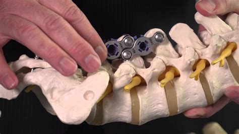 Aurora Spine With An Entirely New Solution For Spinal Implant