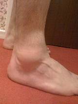 Pictures of How To Speed Up Ankle Sprain Recovery